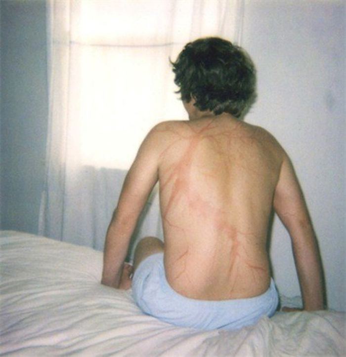 19 человек, выживших после попадания молнии, которая оставила на их телах несмываемые узоры