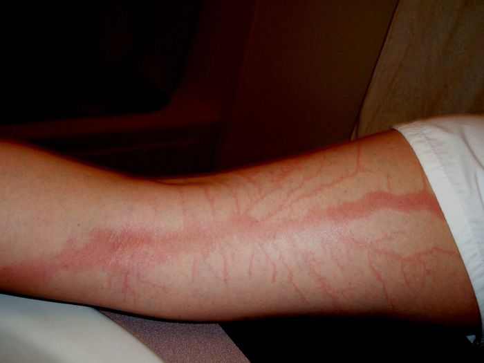 19 человек, выживших после попадания молнии, которая оставила на их телах несмываемые узоры